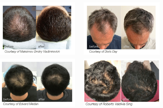 HAIRestart® _ Fotona