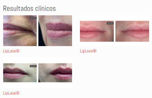 LipLase® _ Fotona