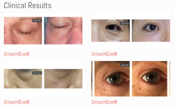 SmoothEye® _ Fotona -